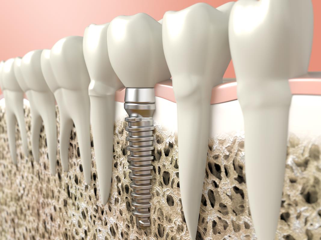 Dental Implants  Dunedin, FL -