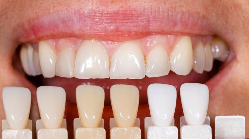 Veneers  Dunedin, FL -